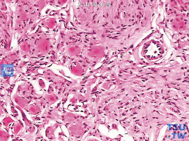 肾上腺节细胞神经瘤，示节细胞周围常有扁平的卫星细胞包绕