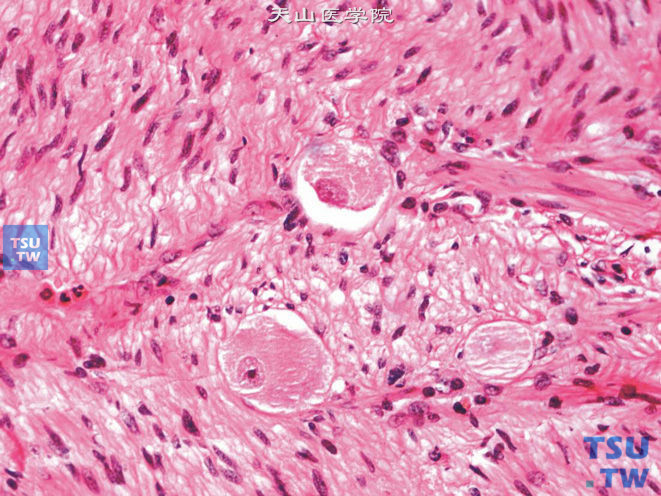 肾上腺节细胞神经瘤，示节细胞体积大，类园或多角形，胞质呈细颗粒状，嗜酸性。核大，染色质细，可见核仁