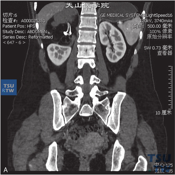 图A：CT，肾上腺畸胎瘤，女，30岁，体检右肾上腺区占位。右侧肾上腺正常结构未见显示，右肾上腺区见团状脂肪密度灶，其内见略高密度索条及结节状钙化灶，边缘清晰，增强后索条可见轻度强化，余强化不明显