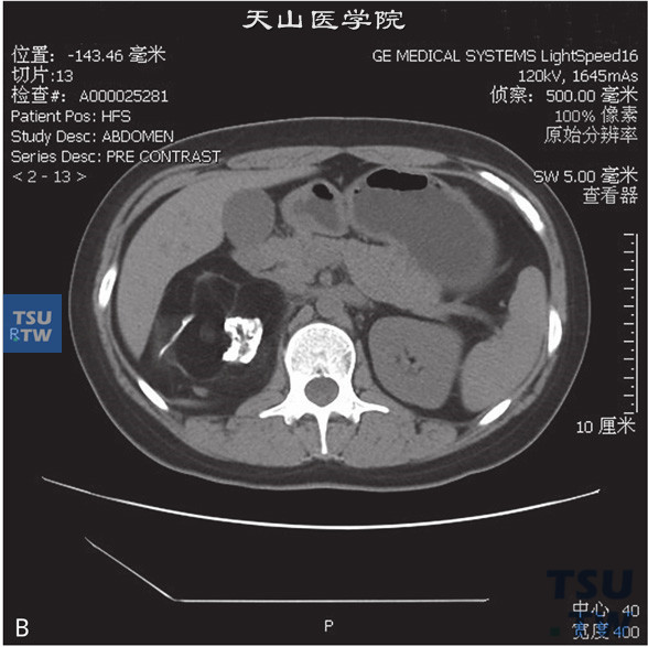 图B：CT，肾上腺畸胎瘤，女，30岁，体检右肾上腺区占位。右侧肾上腺正常结构未见显示，右肾上腺区见团状脂肪密度灶，其内见略高密度索条及结节状钙化灶，边缘清晰，增强后索条可见轻度强化，余强化不明显