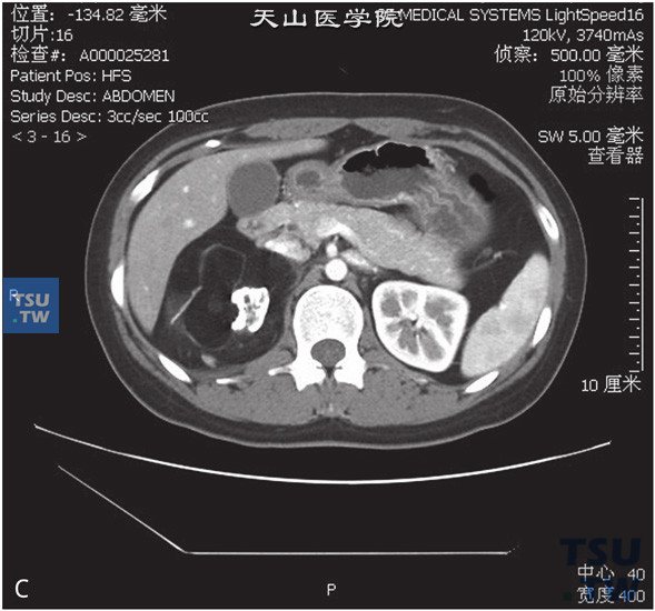 图c：CT，肾上腺畸胎瘤，女，30岁，体检右肾上腺区占位。右侧肾上腺正常结构未见显示，右肾上腺区见团状脂肪密度灶，其内见略高密度索条及结节状钙化灶，边缘清晰，增强后索条可见轻度强化，余强化不明显