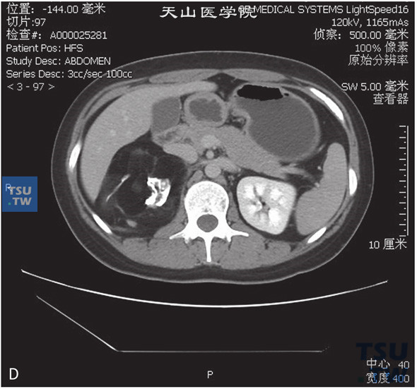 图D：CT，肾上腺畸胎瘤，女，30岁，体检右肾上腺区占位。右侧肾上腺正常结构未见显示，右肾上腺区见团状脂肪密度灶，其内见略高密度索条及结节状钙化灶，边缘清晰，增强后索条可见轻度强化，余强化不明显