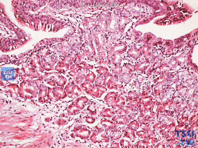 肾上腺成熟性畸胎瘤，示杂乱的消化道腺体及黏膜成分