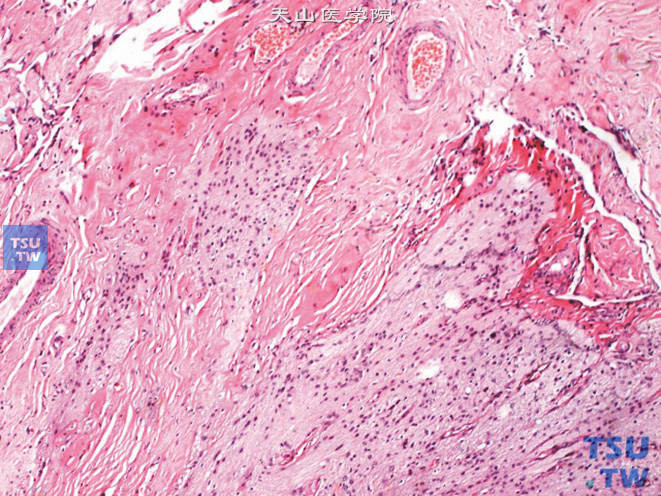 肾上腺成熟性畸胎瘤，可见脑组织