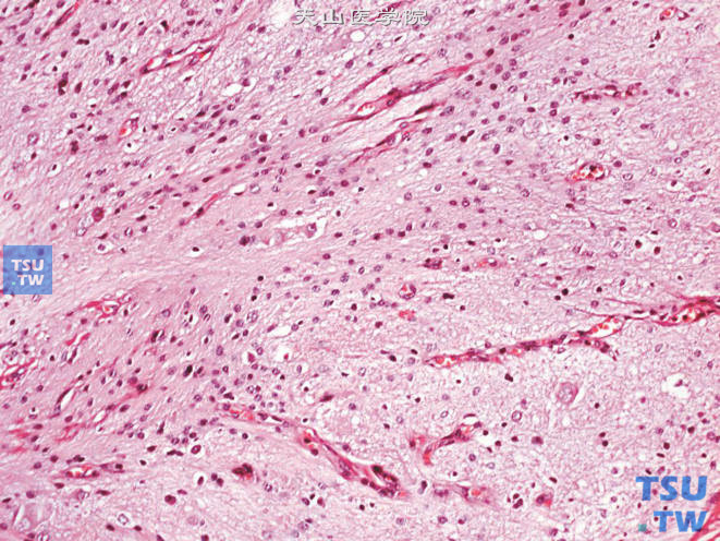 肾上腺成熟性畸胎瘤，可见脑组织（上图高倍）