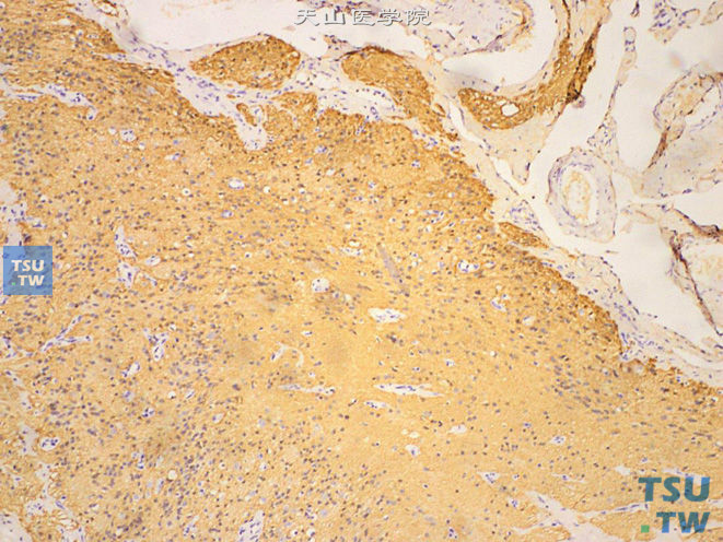 肾上腺成熟性畸胎瘤，可见脑组织，免疫组化：S-100（+）