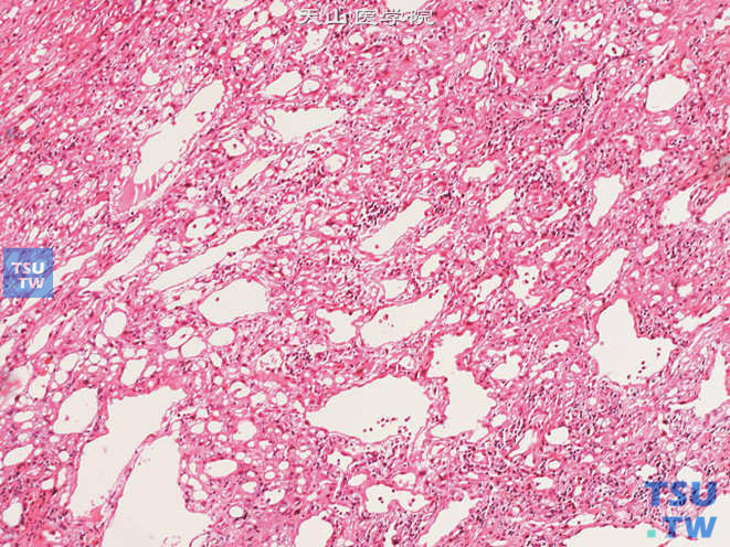 肾上腺腺瘤样瘤，可见不规则腔隙及间皮样细胞
