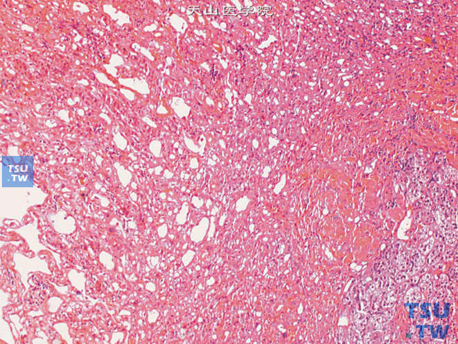 肾上腺腺瘤样瘤，示瘤细胞排列较杂乱。右下方为少许肾上腺皮质