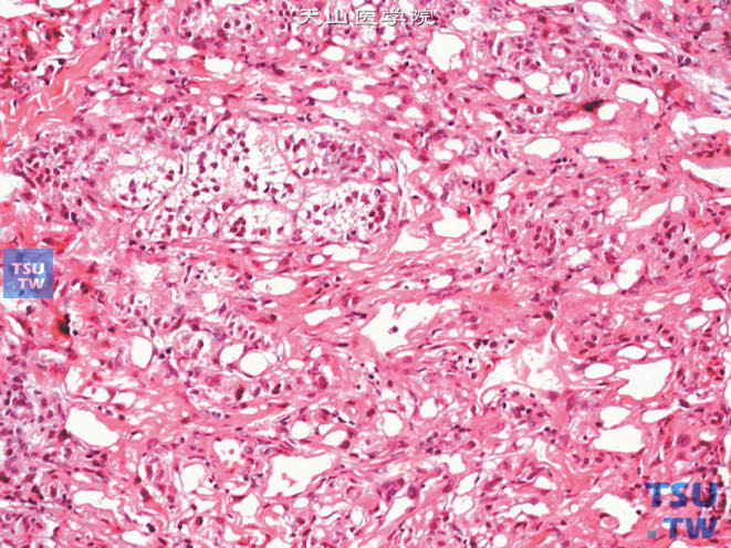 肾上腺腺瘤样瘤，细胞形态呈上皮及间质双向分化。部分瘤细胞胞质呈空泡状，肿瘤组织中可见残存的肾上腺组织