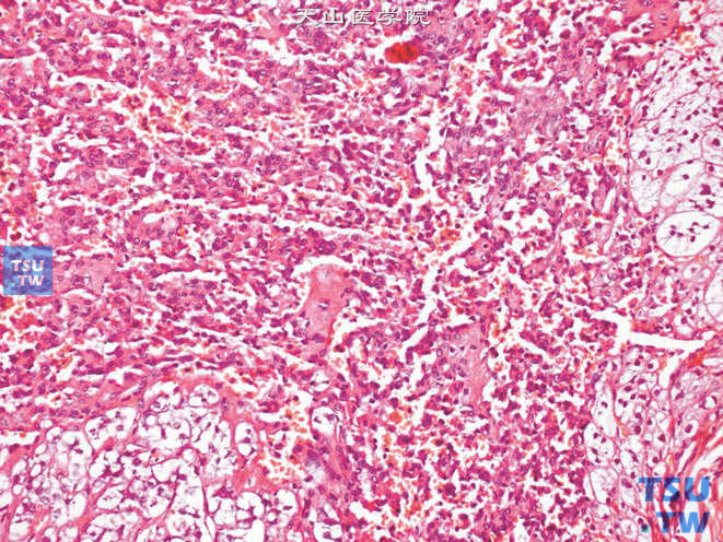 肾上腺血管瘤，可见相互连通的不规则血管腔隙