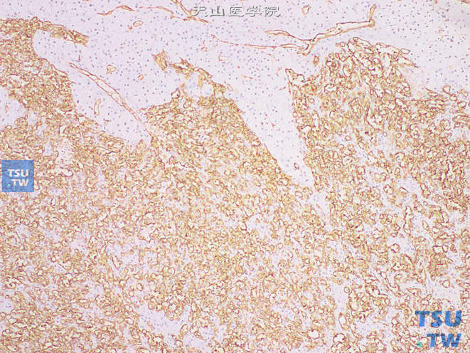 肾上腺血管瘤，免疫组化：CD34（+）