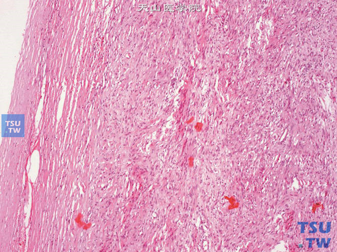 肾上腺神经鞘瘤，由梭形细胞构成，可见包膜
