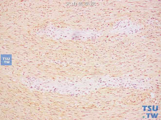 肾上腺神经鞘瘤，免疫组化：S-100（+）
