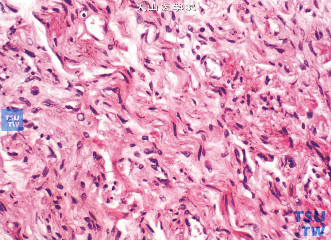 肾上腺神经纤维瘤，示长形、波浪状两端变尖的核