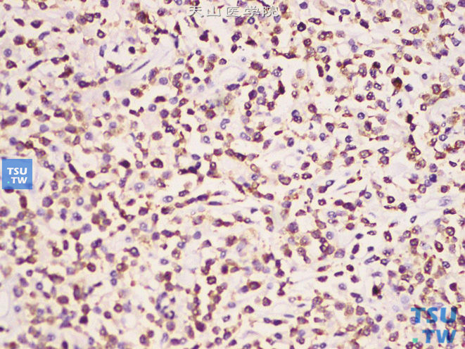 肾上腺T细胞淋巴瘤，免疫组化：CD3（+）