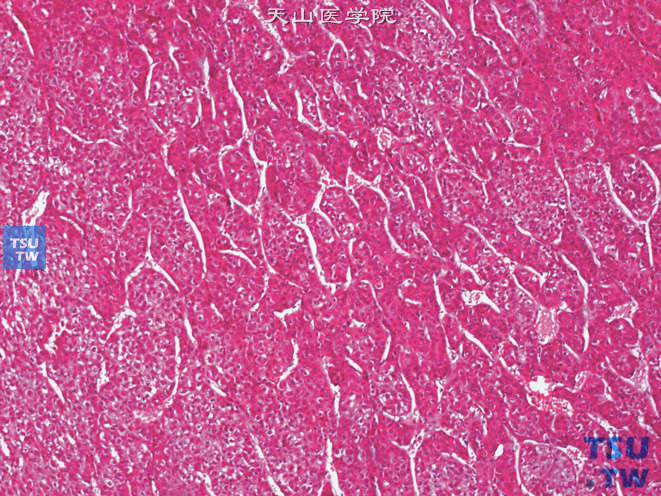 肾上腺区肝细胞性肝癌（原发性），示瘤细胞呈条索状排列，宽度不一。间质由衬覆单层内皮细胞的血窦样腔隙组成