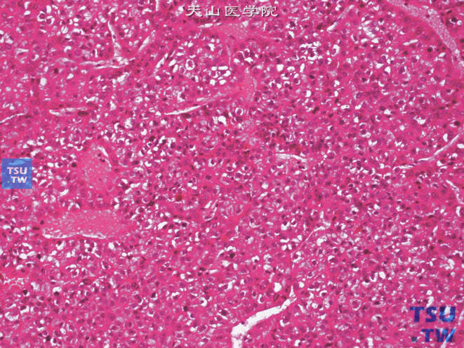 肾上腺区肝细胞性肝癌，可见胆汁生成