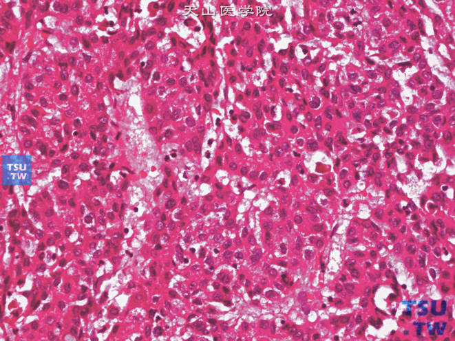 肾上腺区肝细胞性肝癌（原发性），示有胆汁生成。上图高倍