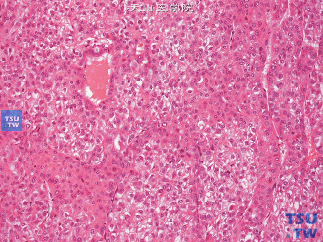 肾上腺区肝细胞性肝癌（原发性），瘤细胞呈多角形，可见胆栓