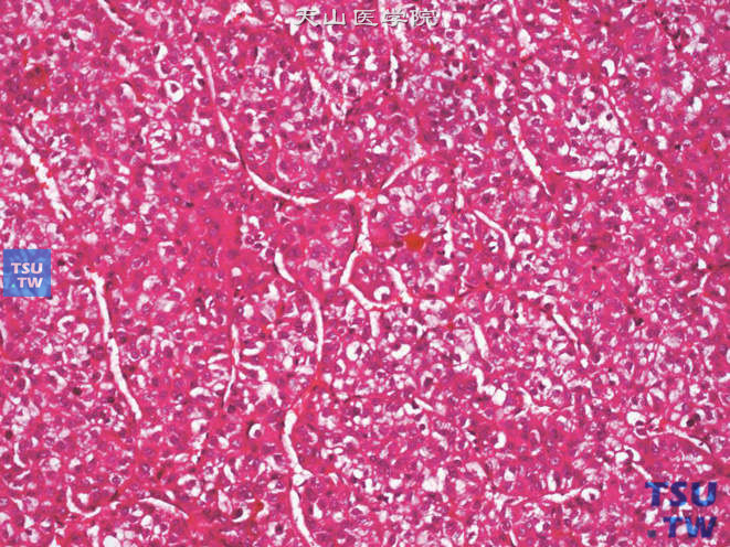 肾上腺区肝细胞性肝癌（原发性），可见胆栓