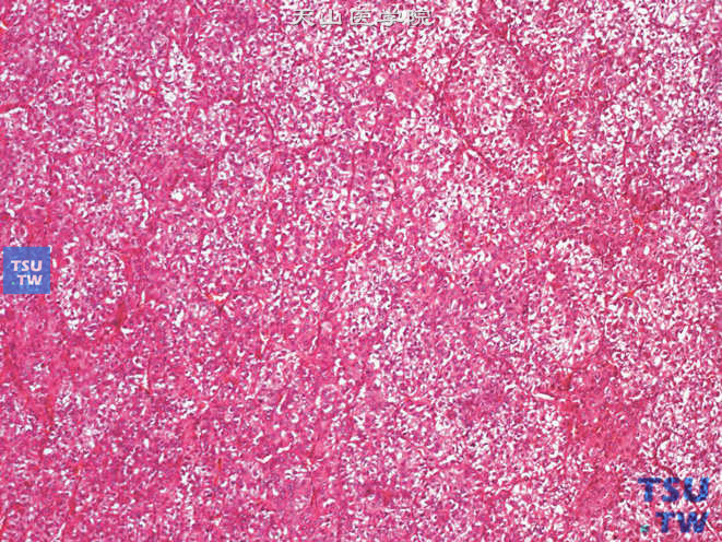 肾上腺区肝细胞性肝癌（原发性），部分区域胞质透明