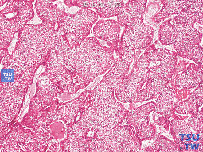 肾上腺区肝细胞性肝癌（原发性），部分区域胞质透明，瘤细胞被血窦样腔隙分隔