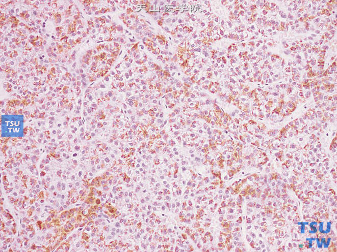 肾上腺区肝细胞性肝癌（原发性），Hepatocyte（+）