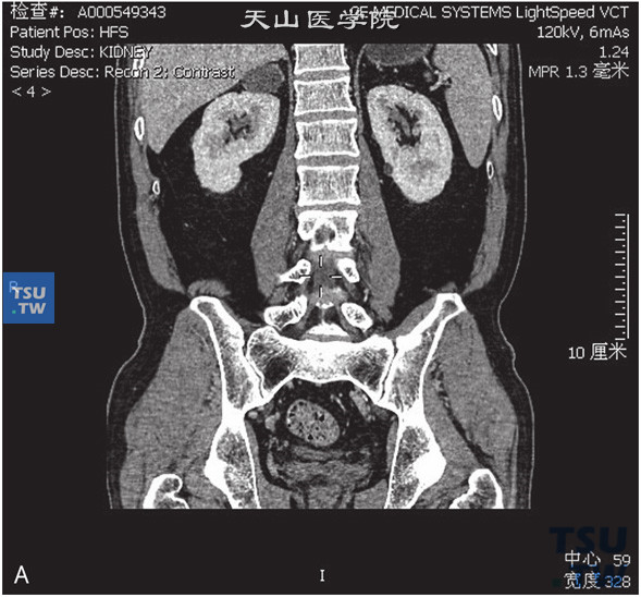 图A：CT，肾上腺囊肿，女，37岁，体检右肾上腺占位。右肾上腺外肢可见囊性水样密度灶，边缘清晰，增强后未见强化
