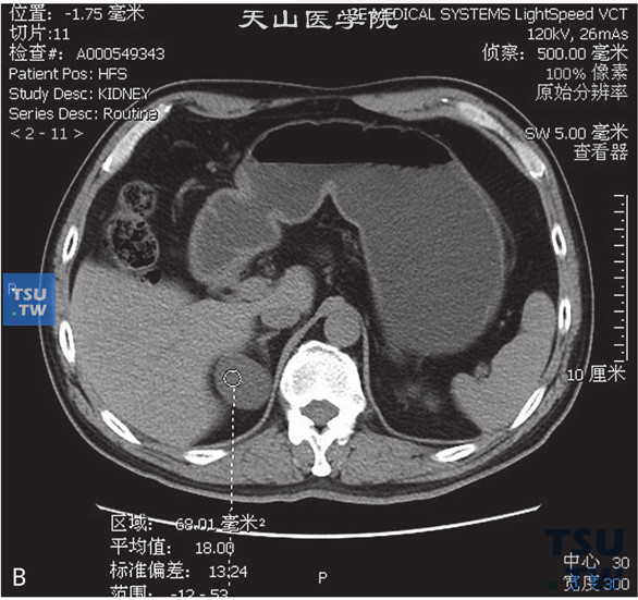 图B：CT，肾上腺囊肿，女，37岁，体检右肾上腺占位。右肾上腺外肢可见囊性水样密度灶，边缘清晰，增强后未见强化
