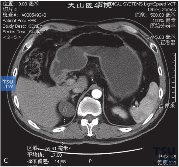图C：CT，肾上腺囊肿，女，37岁，体检右肾上腺占位。右肾上腺外肢可见囊性水样密度灶，边缘清晰，增强后未见强化