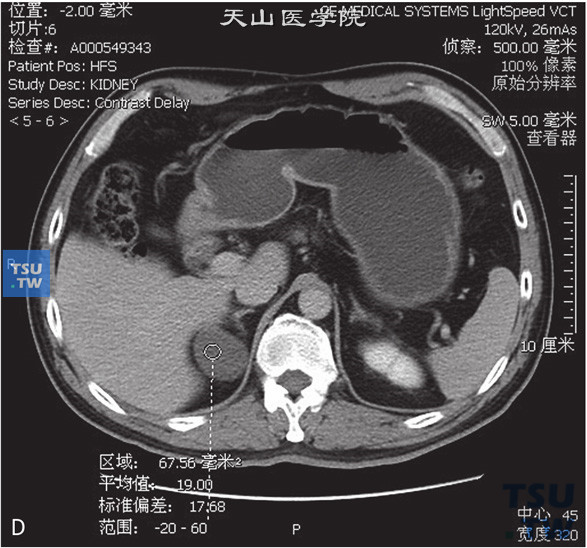 图D：CT，肾上腺囊肿，女，37岁，体检右肾上腺占位。右肾上腺外肢可见囊性水样密度灶，边缘清晰，增强后未见强化