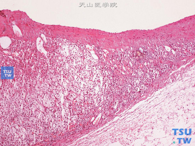 肾上腺囊肿，被覆单层扁平上皮细胞