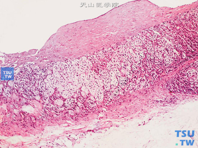 肾上腺囊肿，可见纤维性囊壁，周围可见肾上腺组织