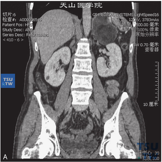 图A：CT：肾上腺髓脂肪瘤，男，46岁，CA19-9升高。左肾上腺见一不均匀低密度灶，可见片状脂肪密度灶，边缘清晰，增强后强化不明显
