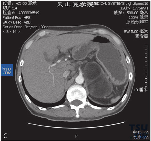 图B：CT：肾上腺髓脂肪瘤，男，46岁，CA19-9升高。左肾上腺见一不均匀低密度灶，可见片状脂肪密度灶，边缘清晰，增强后强化不明显