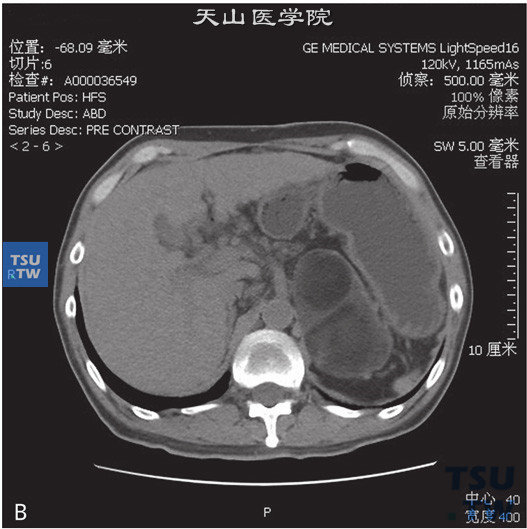 图C：CT：肾上腺髓脂肪瘤，男，46岁，CA19-9升高。左肾上腺见一不均匀低密度灶，可见片状脂肪密度灶，边缘清晰，增强后强化不明显