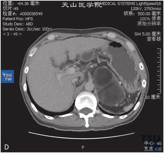 图D：CT：肾上腺髓脂肪瘤，男，46岁，CA19-9升高。左肾上腺见一不均匀低密度灶，可见片状脂肪密度灶，边缘清晰，增强后强化不明显