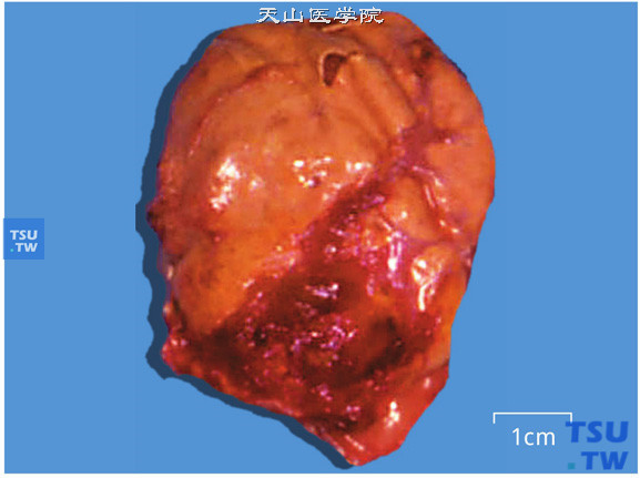 肾上腺髓细胞脂肪瘤（大体）。肿瘤质地柔软，与周围分界清