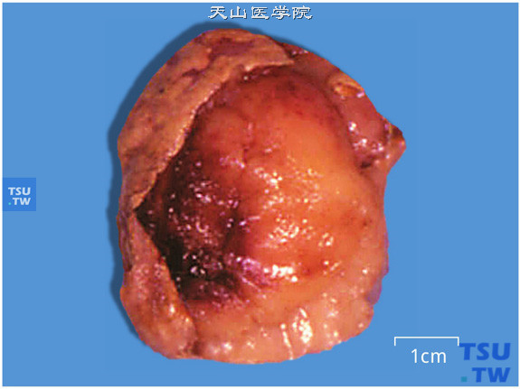 肾上腺髓细胞脂肪瘤病理图谱