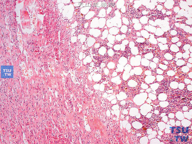 肾上腺髓细胞脂肪瘤，由脂肪和造血组织构成。左侧为肾上腺组织