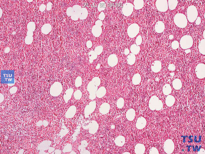 肾上腺髓细胞脂肪瘤，本例以髓细胞成分为主