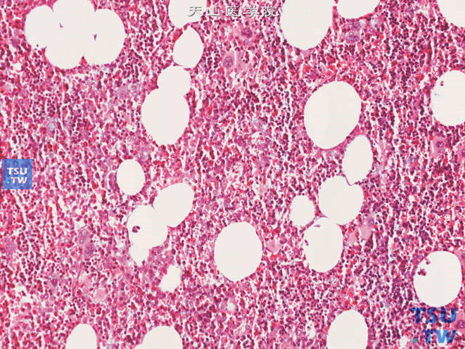肾上腺髓细胞脂肪瘤，本例以髓细胞为主，可见较多巨核细胞