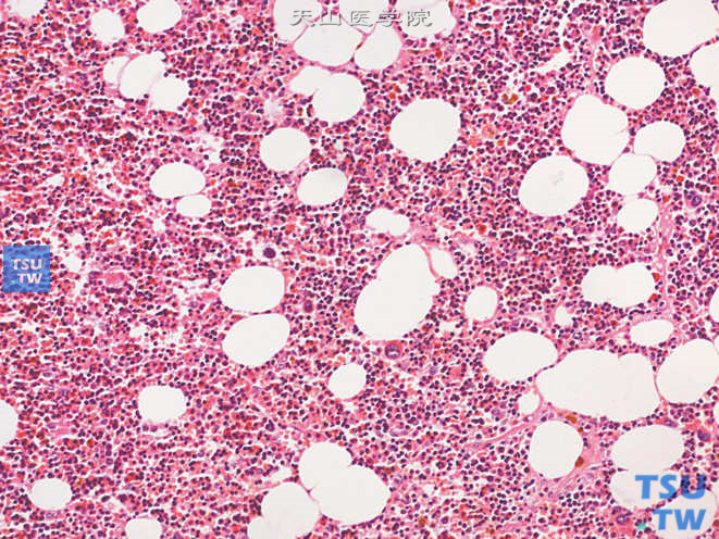 肾上腺髓细胞脂肪瘤，造血组织中有三种血细胞系细胞