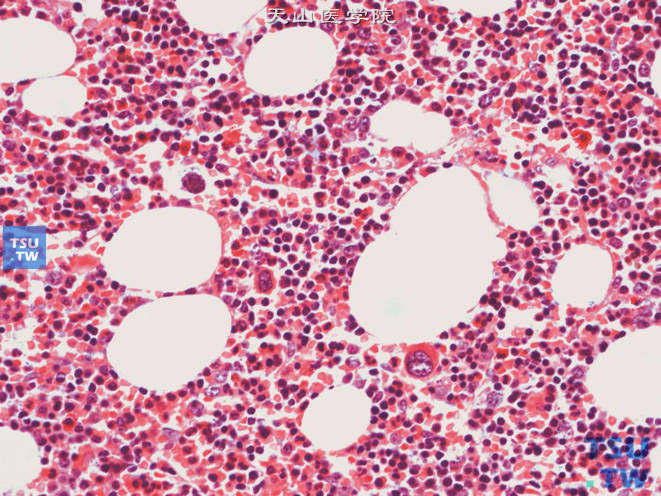 肾上腺髓细胞脂肪瘤，上图高倍，示三种血细胞系的细胞
