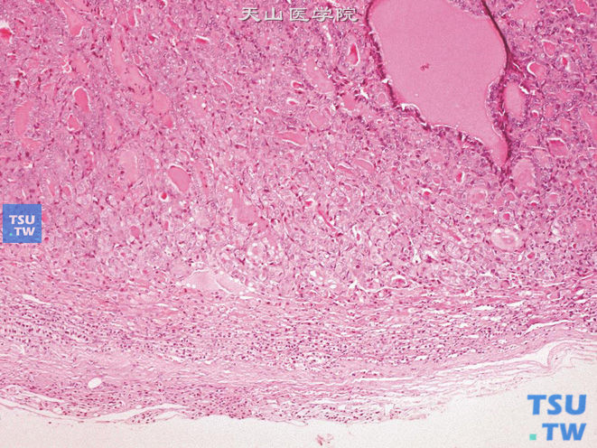 肾上腺转移性甲状腺癌，可见滤泡状结构，下方为少许肾上腺皮质组织