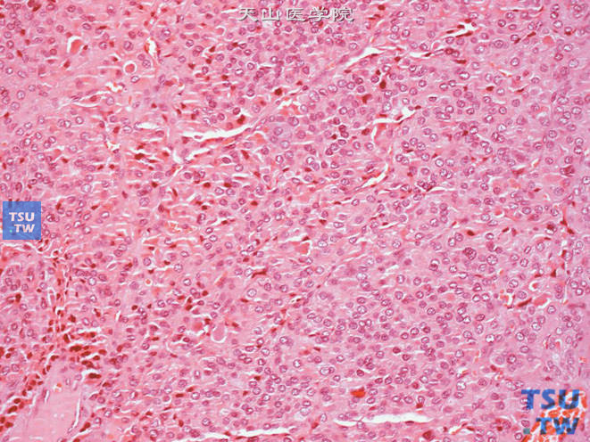 肾上腺转移性甲状腺癌，部分区域肿瘤细胞呈片状排列，滤泡结构不明显或消失
