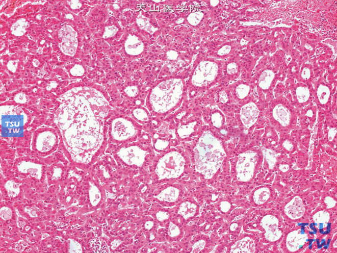 肾上腺转移性肝细胞性肝癌，假腺样（腺泡）型，腺样结构由单层肿瘤细胞构成