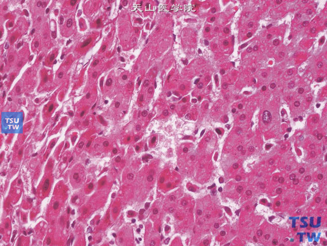 肾上腺转移性肝细胞性肝癌，示球形透明小体