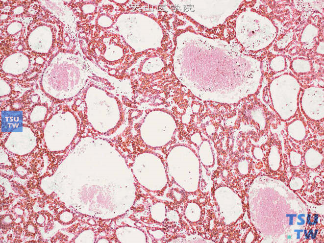 肾上腺转移性肝细胞性肝癌，免疫组化：Hepatocyte（+）