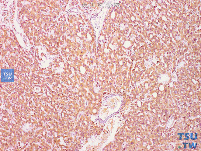肾上腺转移性肝细胞性肝癌，免疫组化：AFP（+）